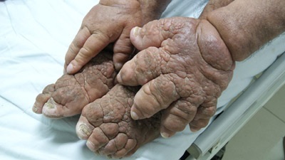 Người đàn ông mắc chứng da “vỏ cam” - 1