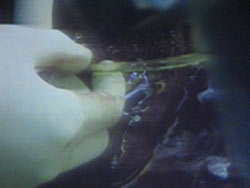 Ca ghép gan tại Viện Nhi Trung ương đã thành công mỹ mãn - 5 Ca ghép gan tại Viện Nhi Trung ương đã thành công mỹ mãn - 5