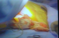 Ca ghép gan tại Viện Nhi Trung ương đã thành công mỹ mãn - 10 Ca ghép gan tại Viện Nhi Trung ương đã thành công mỹ mãn - 10