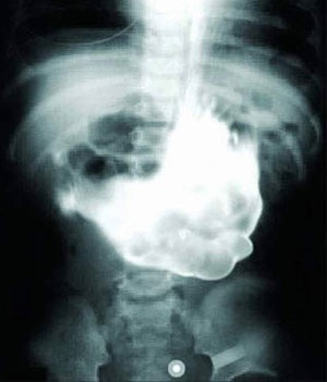 Những chiếc dạ dày “khủng” - 2