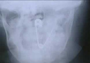 Những chiếc dạ dày “khủng” - 6