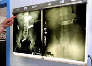 Những chiếc dạ dày “khủng” - 5