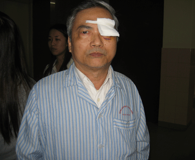 Mù vĩnh viễn vì chủ quan với bệnh Glôcôm - 1 Mù vĩnh viễn vì chủ quan với bệnh Glôcôm - 1