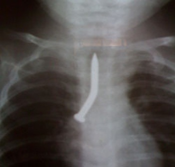 Bé 6 tháng tuổi nuốt đinh vào cuống phổi - 1