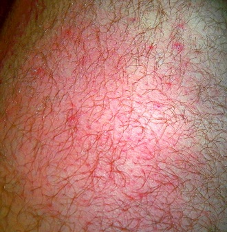 iPhone 3G cháy bỏng chân người dùng - 3 iPhone 3G cháy bỏng chân người dùng - 3