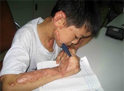 Gặp lại cháu bé bị cha đốt - 1