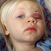 2 tuổi, thoát chết sau khi bị tua vít xuyên vào đầu - 1 2 tuổi, thoát chết sau khi bị tua vít xuyên vào đầu - 1