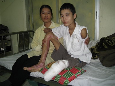 3 lần xả thân cứu bạn, em đã vĩnh viễn tàn phế - 2