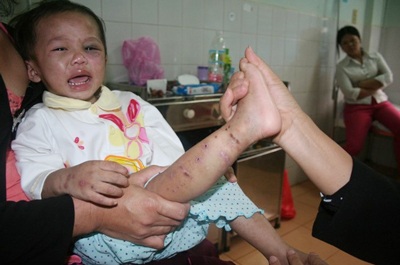 Bé gái 2 tuổi bị cắt ngón chân, đánh hộc máu - 2