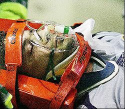 Petr Cech phải phẫu thuật vì vỡ xương sọ - 4