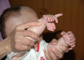 Cậu bé có bàn chân 6 ngón, bàn tay 8 ngón - 1