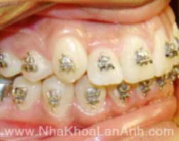 Làm gì khi răng mọc lệch lạc, hô hay móm? - 2 Làm gì khi răng mọc lệch lạc, hô hay móm? - 2