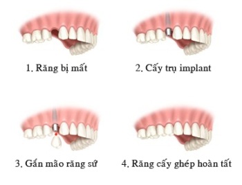 Implant nha khoa phần 2: Lợi ích của Implant - 2