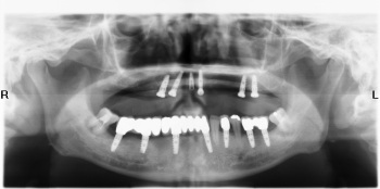 Sự cần thiết của X-quang toàn cảnh kỹ thuật số trong điều trị nha khoa - 3 Sự cần thiết của X-quang toàn cảnh kỹ thuật số trong điều trị nha khoa - 3