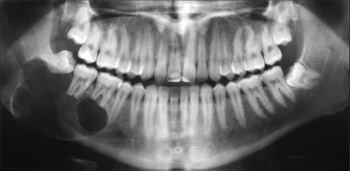 Sự cần thiết của X-quang toàn cảnh kỹ thuật số trong điều trị nha khoa - 4 Sự cần thiết của X-quang toàn cảnh kỹ thuật số trong điều trị nha khoa - 4