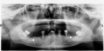 Sử dụng X-quang trong Nha khoa - 1