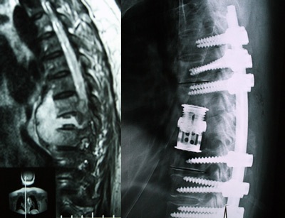 Hy vọng cho người bị chấn thương cột sống - 1 Hy vọng cho người bị chấn thương cột sống - 1