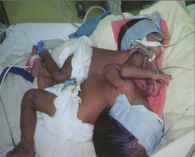 Tách thành công trẻ song sinh non tháng, nhẹ cân, dính ngực bụng - 1