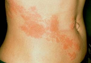 Ớt cay giúp giảm đau do zona? - 1 Ớt cay giúp giảm đau do zona? - 1