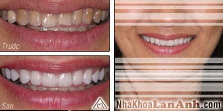 Răng sậm màu và phương pháp cải thiện - 3 Răng sậm màu và phương pháp cải thiện - 3