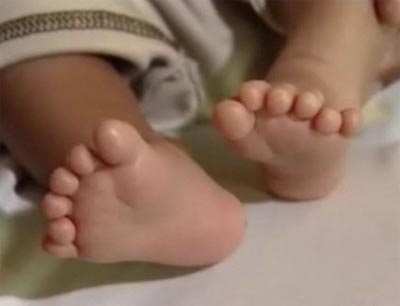 Bé sơ sinh có 12 ngón chân và 12 ngón tay - 1 Bé sơ sinh có 12 ngón chân và 12 ngón tay - 1