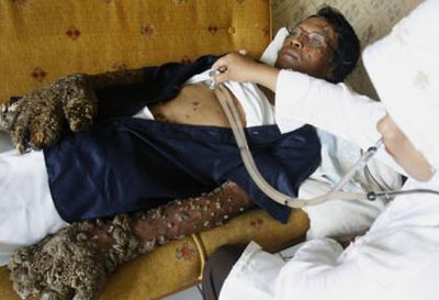 “Người cây” của Indonesia mọc rễ trở lại - 3