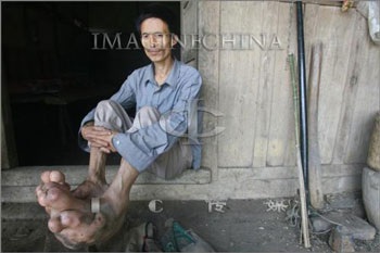 Người đàn ông có đôi chân khổng lồ - 4