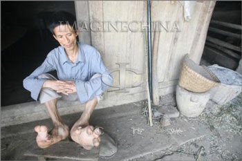 Người đàn ông có đôi chân khổng lồ - 5