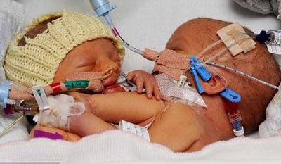 Tách cặp song sinh dính liền 1 tuần tuổi ở Anh - 1