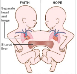 Tách cặp song sinh dính liền 1 tuần tuổi ở Anh - 4