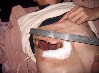 "Vá" ngực bằng vỏ bao thuốc lá - 1