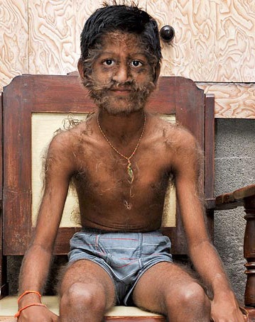 “Cậu bé ma sói” ở Ấn Độ - 6