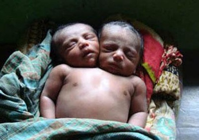 Em bé hai đầu gây sốc ở Bangladesh - 1 Em bé hai đầu gây sốc ở Bangladesh - 1