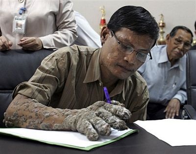 “Người cây” được tạm thời xuất viện - 9