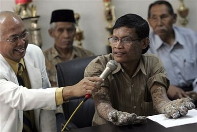 “Người cây” được tạm thời xuất viện - 8