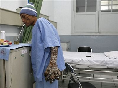 “Người cây” được tạm thời xuất viện - 3