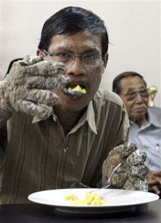 “Người cây” được tạm thời xuất viện - 7