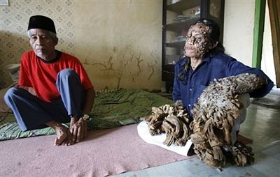 “Người cây” được tạm thời xuất viện - 2