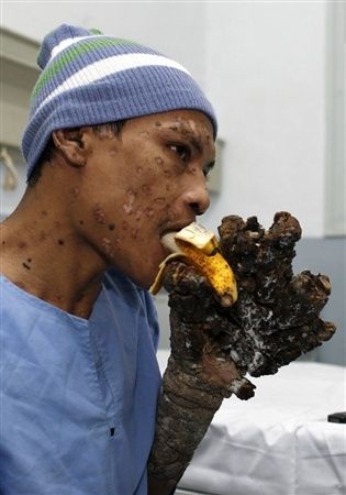 “Người cây” được tạm thời xuất viện - 4