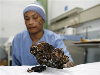 “Người cây” được tạm thời xuất viện - 6