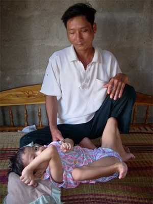 Con bại não, bố mù lòa - 1 Con bại não, bố mù lòa - 1