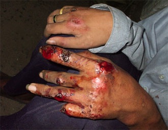 Cảnh đời bệnh phong nghiệt ngã! - 1