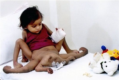 Ca phẫu thuật "thần tốc" cho bé gái 4 chân, 4 tay (kèm video) - 1 Ca phẫu thuật "thần tốc" cho bé gái 4 chân, 4 tay (kèm video) - 1