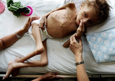 Những hình ảnh đáng sợ của một cậu bé suy dinh dưỡng | Báo Dân trí