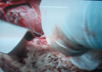 Một học sinh bị đâm thủng tim, phổi - 1