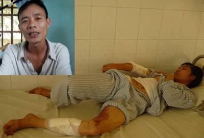 Có thể khởi tố kẻ tạt nồi canh nóng vào người vợ - 1 Có thể khởi tố kẻ tạt nồi canh nóng vào người vợ - 1