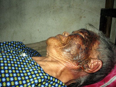 Nàng dâu hắt phích nước sôi vào mặt mẹ chồng - 1