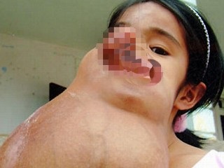 Bé Lài sắp được làm phẫu thuật tại Mỹ - 1