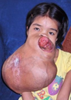 Bé Lài sắp được làm phẫu thuật tại Mỹ - 2