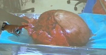 Em Lài còn phải nằm viện 6 tuần nữa - 1